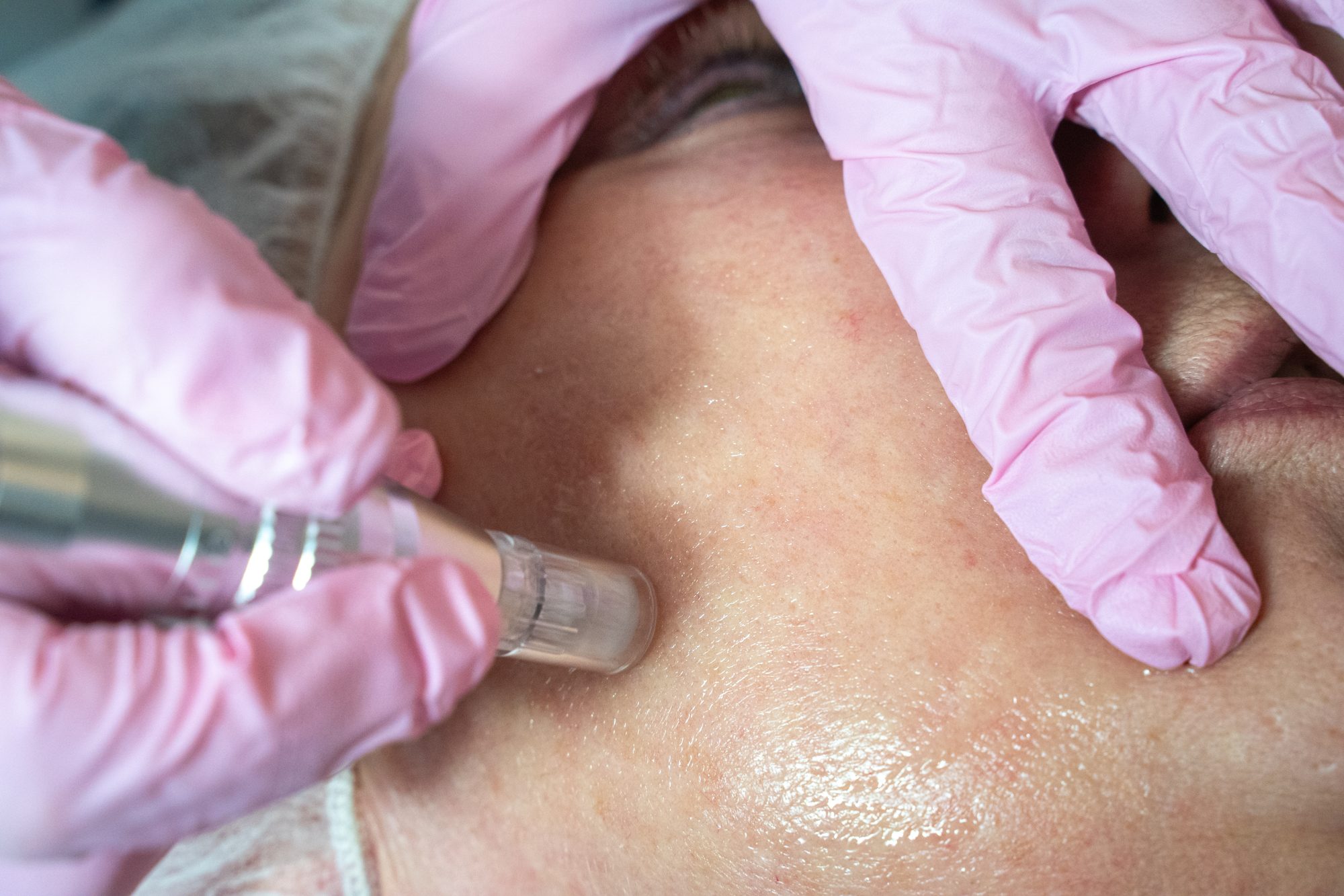 Microneedling-Behandlung im Kosmetikstudio Amiko